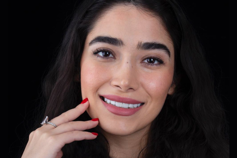 لمینت دندان