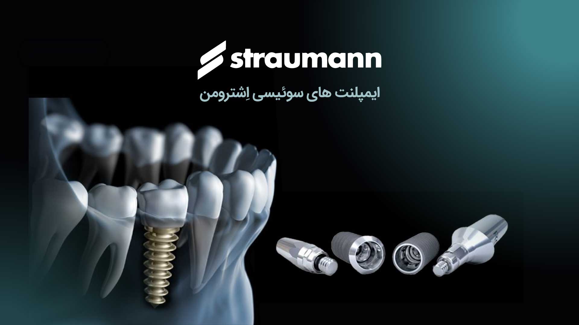 ایمپلنت دندان در تهران