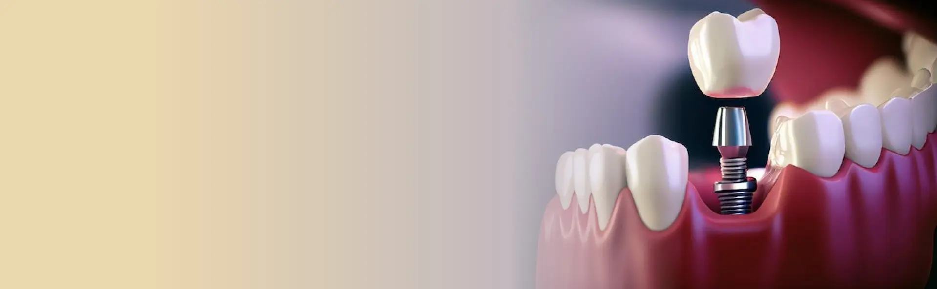 ایمپلنت فوری دندان