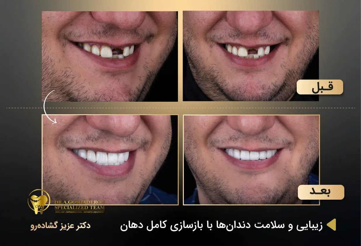 مراحل انجام ایمپلنت فوری دندان