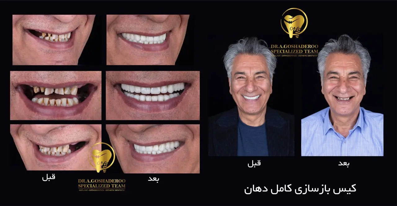 مراقبت‌های بعد از ایمپلنت فوری دندان