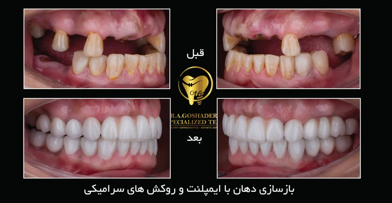 انواع ایمپلنت دندان