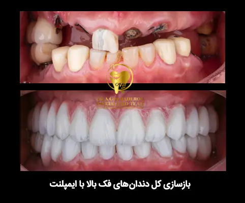 آیا ایمپلنت دندان درد دارد؟