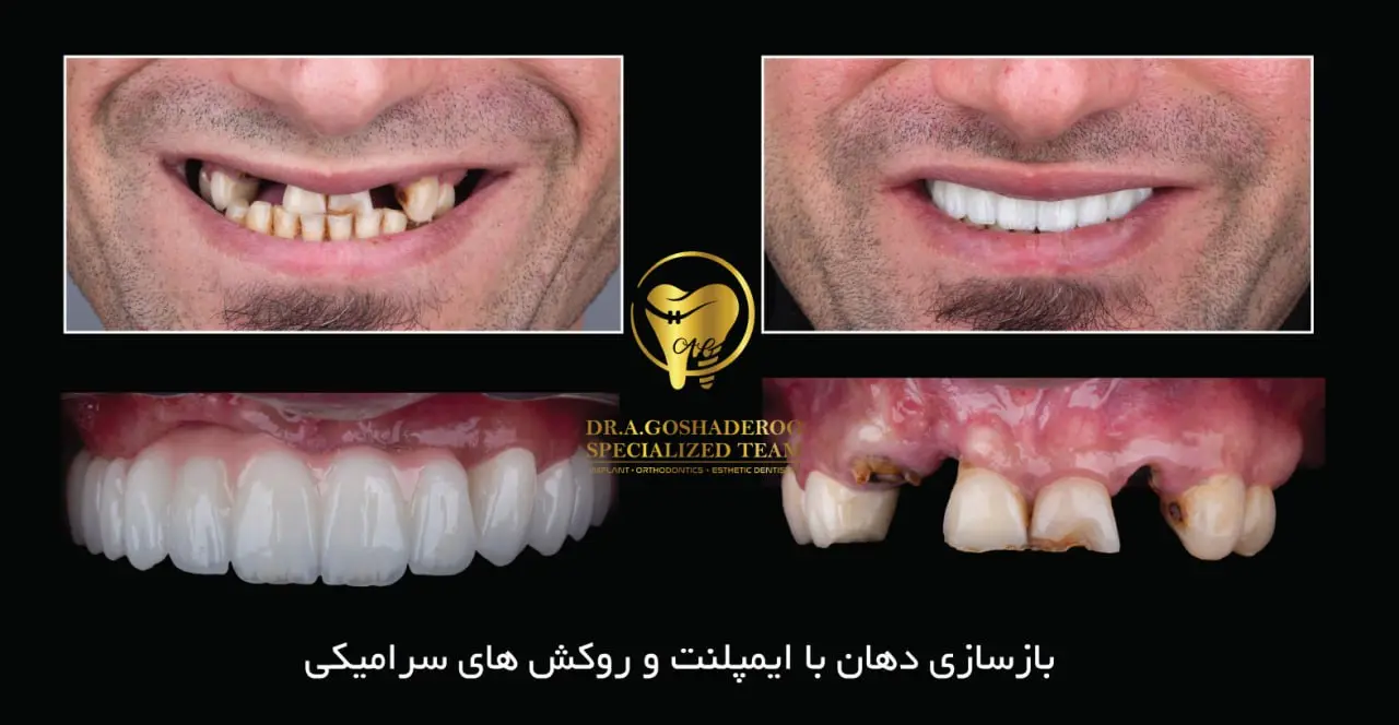 مراحل کاشت ایمپلنت دندان