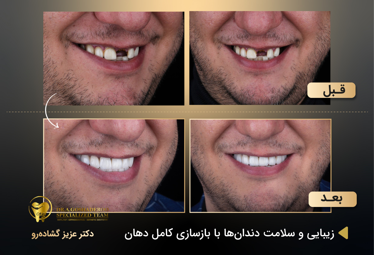 زیبایی و سلامت دندانها با بازسازی کامل دهان