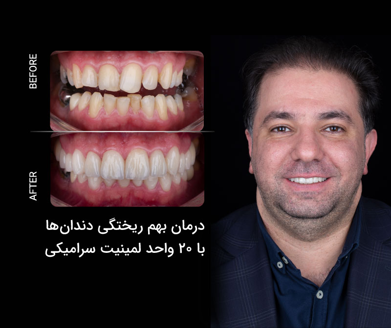 درمان بهم ریختگی دندان ها با 20 واحد لمینیت سرامیکی