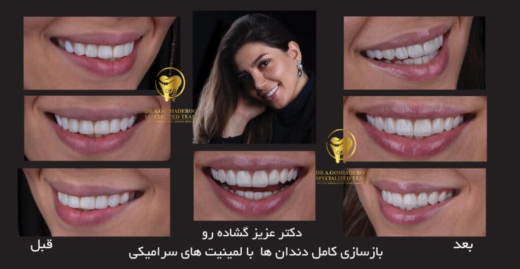 بازسازی کامل دندان ها با لمینت سرامیکی