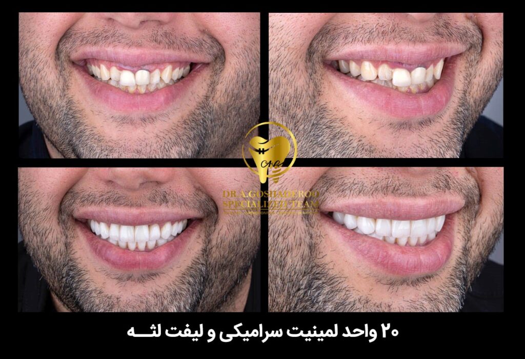 سرامیکی و لیفت لثه