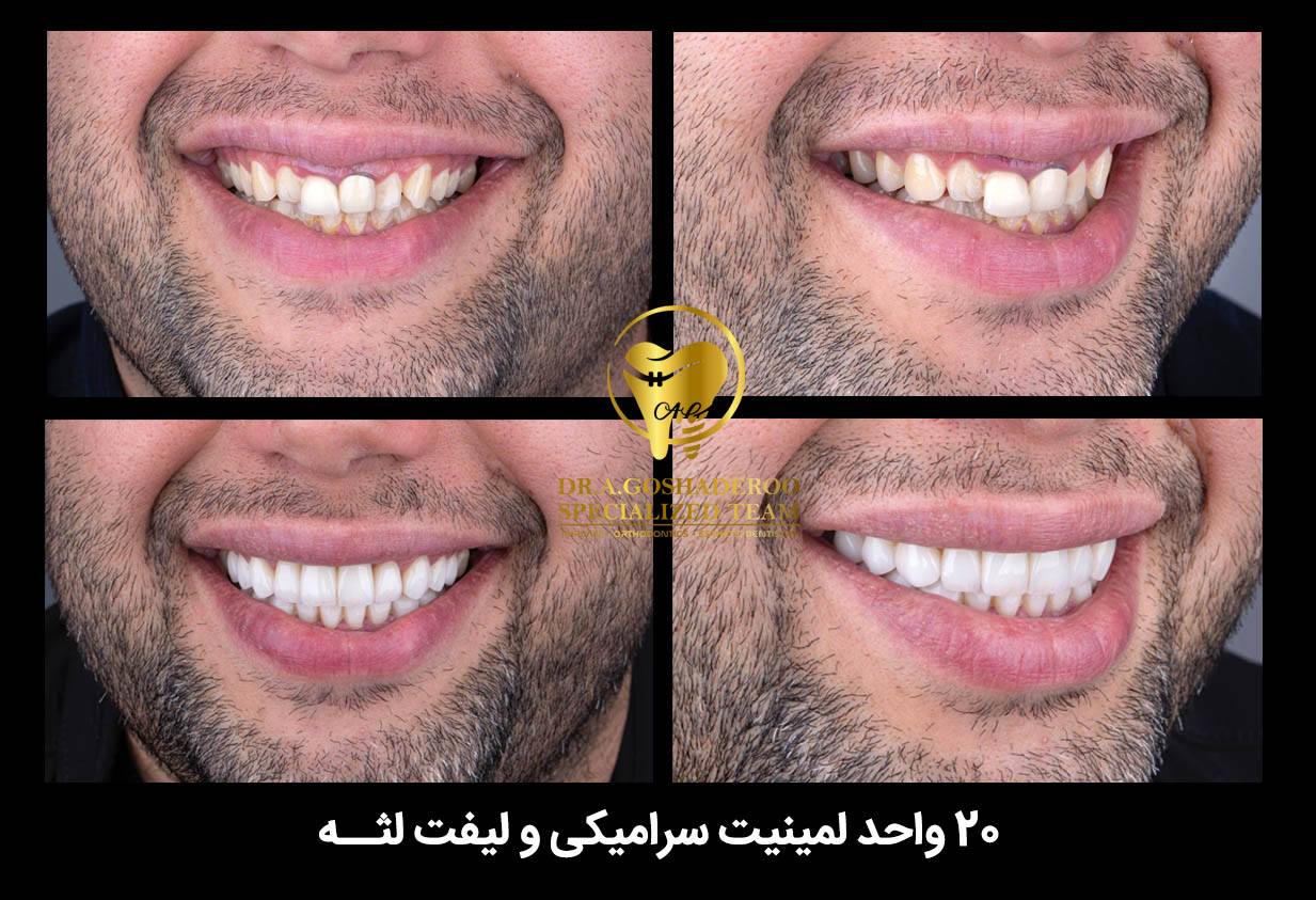 لمینیت سرامیکی دندان