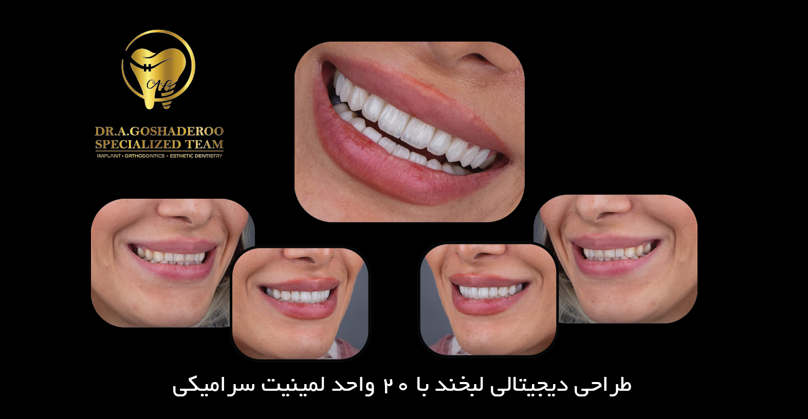 لمینیت سرامیکی دندان