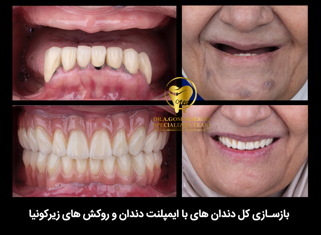 کامپوزیت دندان