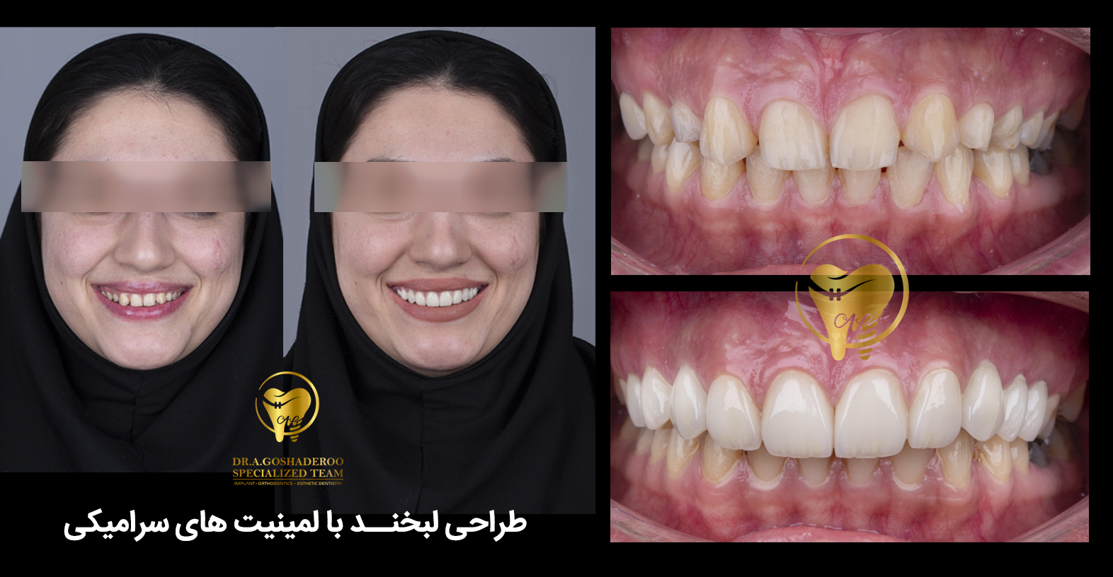 لمینیت سرامیکی دندان