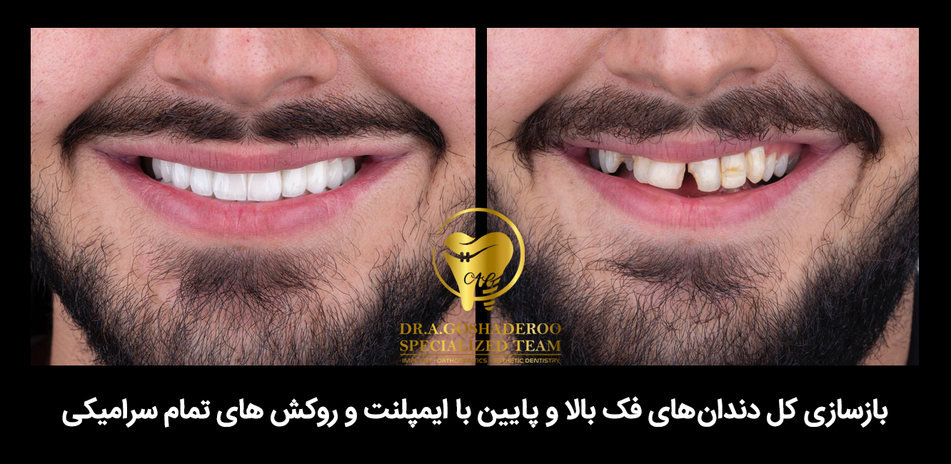 ایمپلنت دندان در شمال تهران