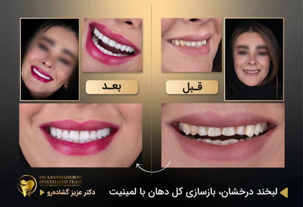 بازسازی کامل دهان با لمینت