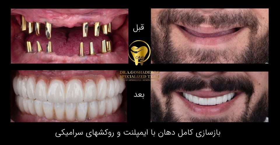 بازسازی کامل دهان با ایمپلنت و روکش سرامیکی
