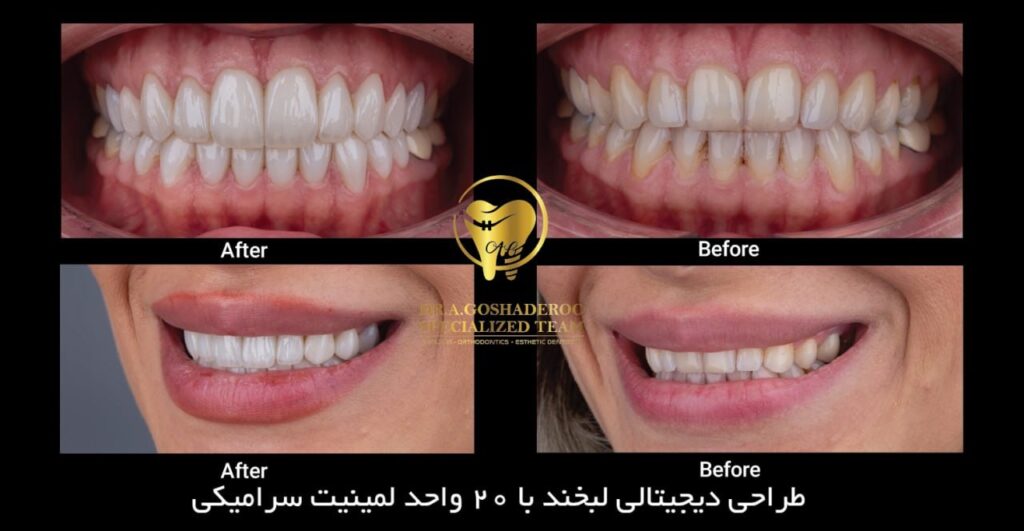 طراحی دیجیتالی لبخند با 20 واحد لمینت سرامیکی
