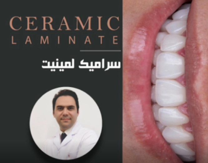 لمینت سرامیکی _ بازسازی دندان