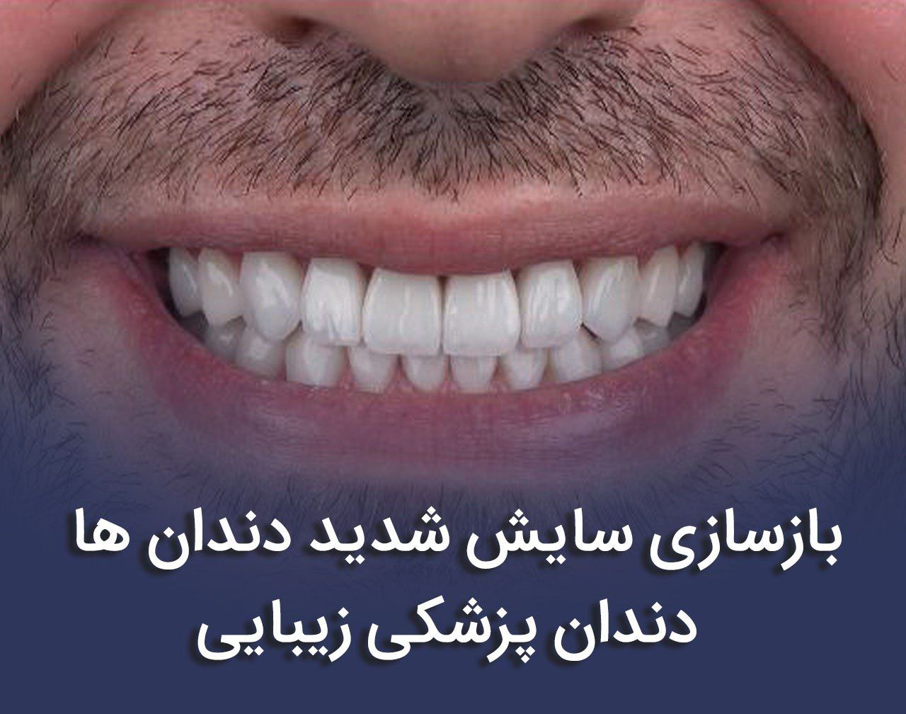 بازسازی کل دهان با لمینیت در بیماران دارای دندان‌های سایش‌یافته