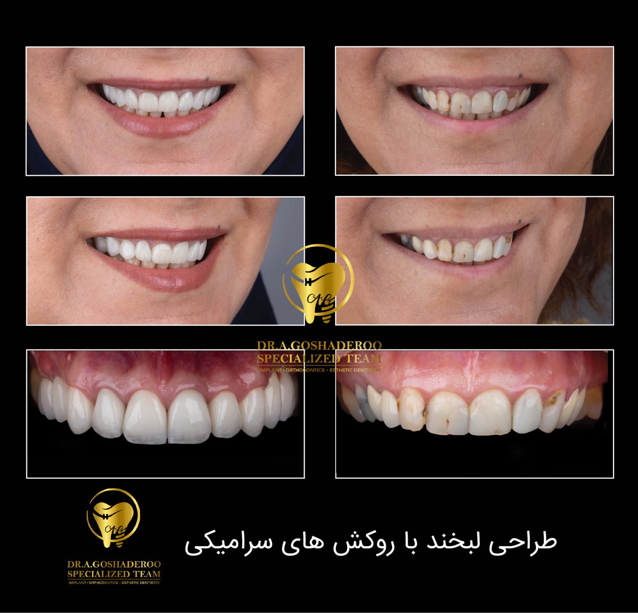 لمینیت سرامیکی دندان