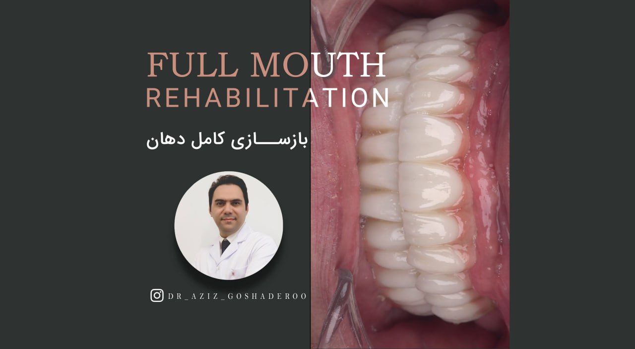 بازسازی کامل دهان با ایمپلنت _ فیلم Full Mouth Rehabilitation