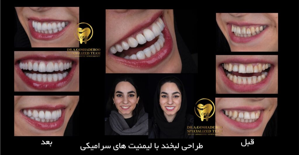 طراحی لبخند با لمینیت های سرامیکی