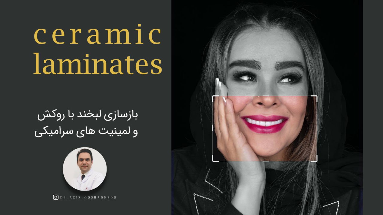 بازسازی لبخند با روکش و لمینیت های سرامیکی