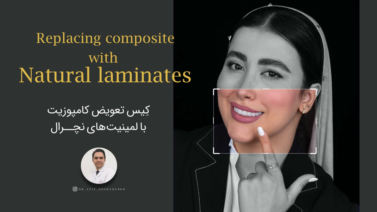 تعویض کامپوزیت با لمیمیت های نچرال