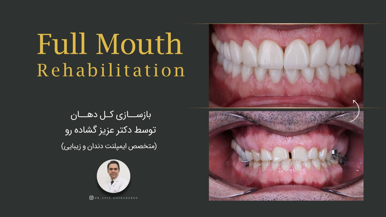 بازسازی کل دهان توسط دکتر عزیز گشاده رو