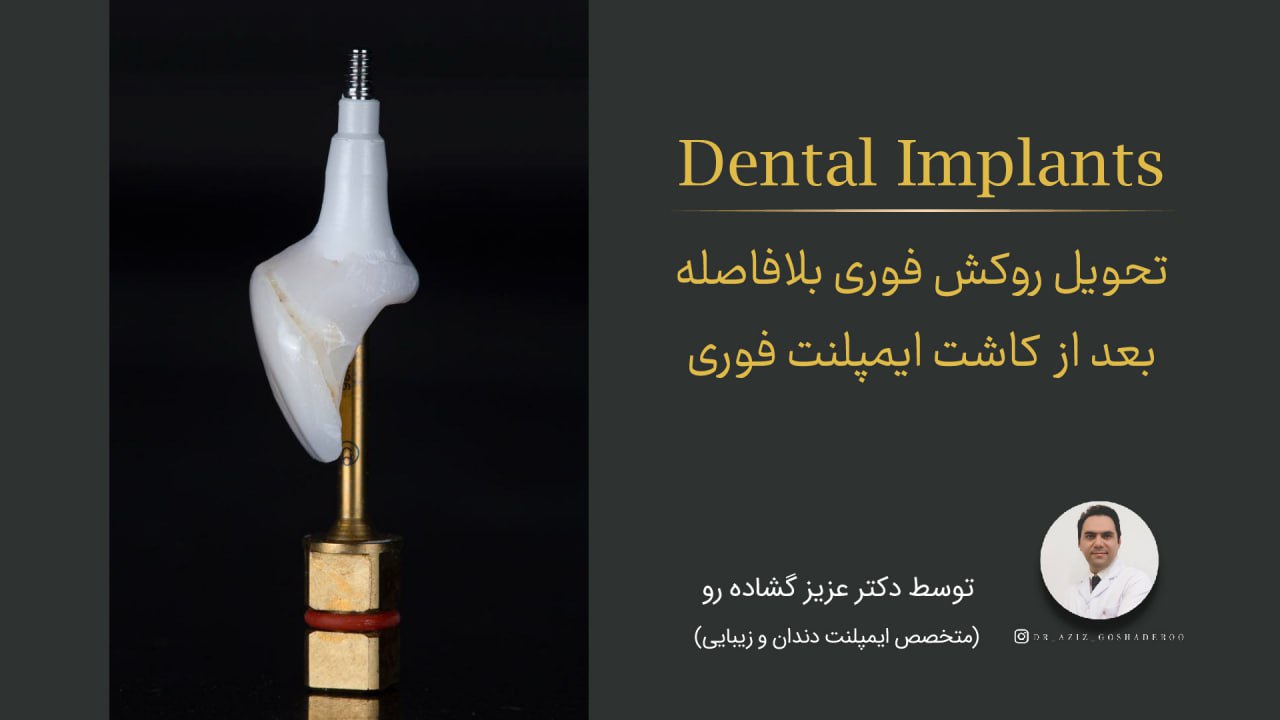 تحویل روکش فوری بلافاصله بعد از کاشت ایمپلنت فوری