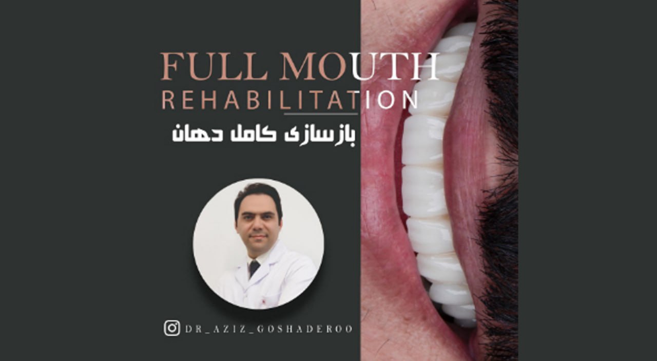 بازسازی کامل دهان با ایمپلنت _ معجزه ایمپلنت