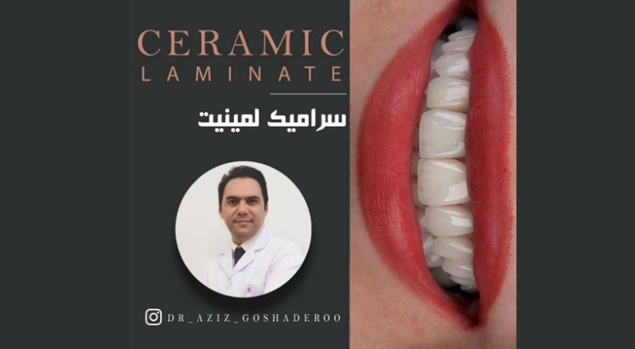 ویدئو نمونه درمان لمینت سرامیکی