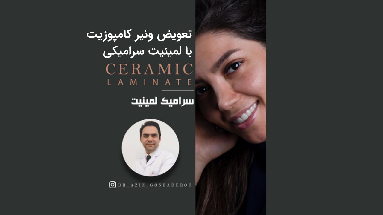 تعویض ونیر کامپوزیت با لمینیت سرامیکی
