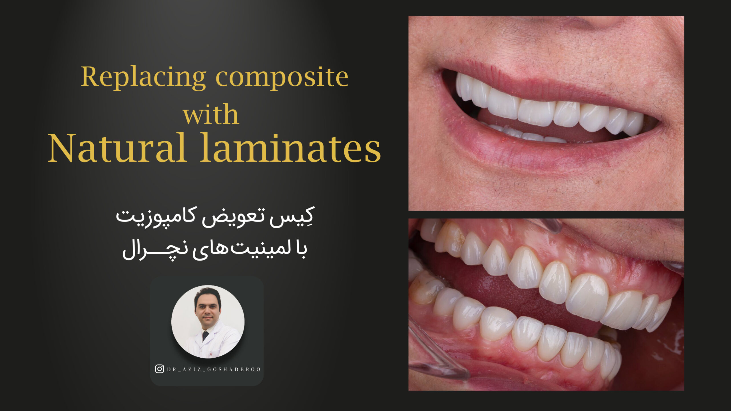 تعویض کامپوزیت با لمینیت های نچرال