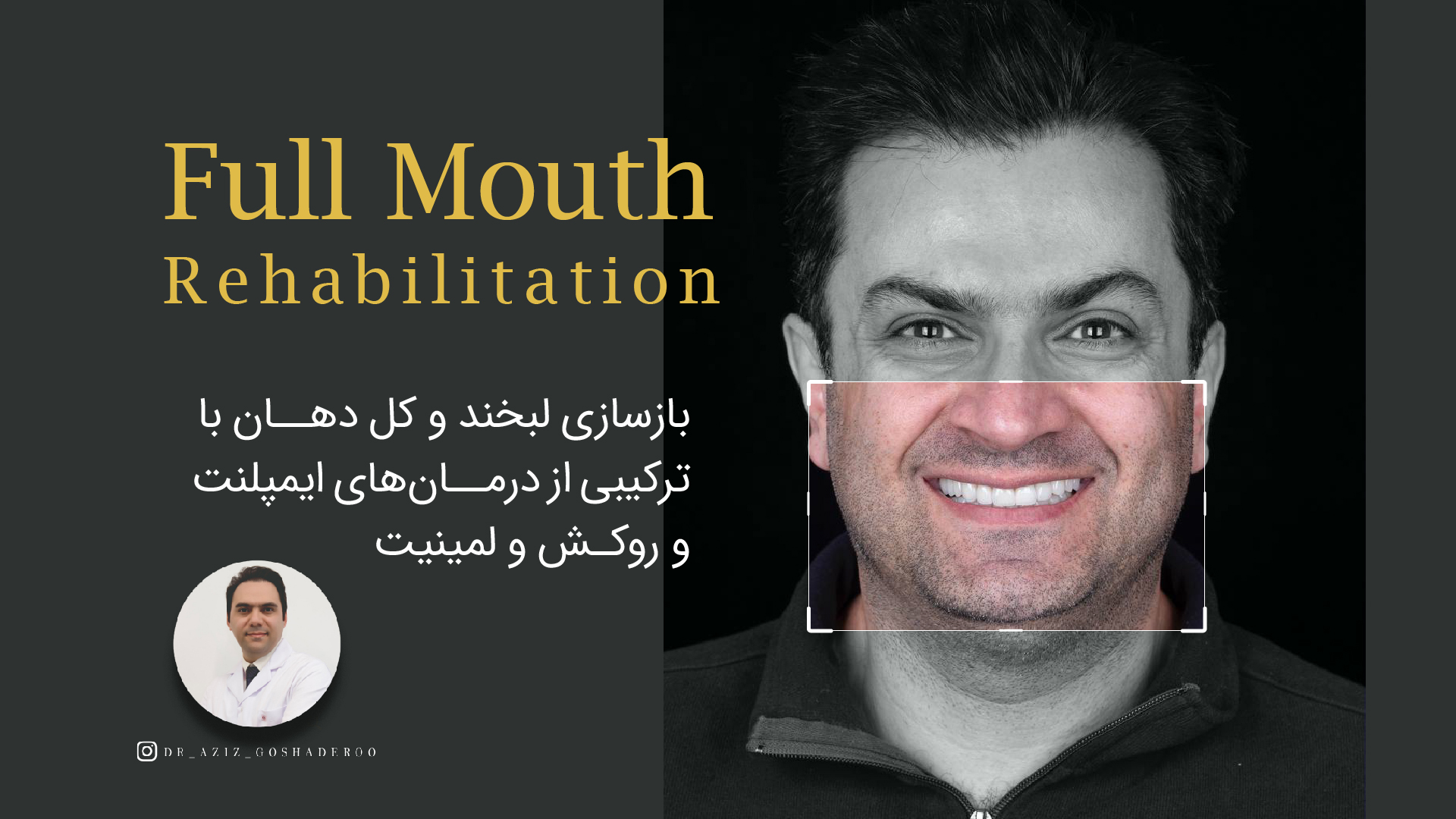 بازسازی لبخندبا درمان های ایمپلنت و روکش و لمینیت