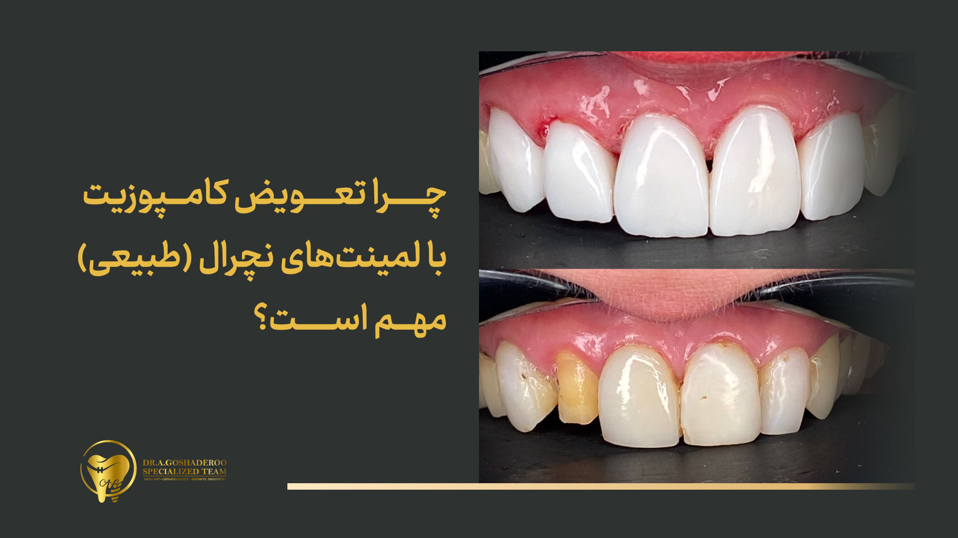  چرا تعویض کامپوزیت با لمینت‌های نچرال (طبیعی) مهم است؟